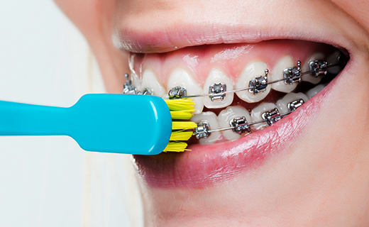dca-blog_proper-brushing-with-braces